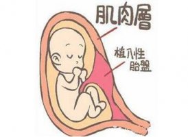 胎盤植入怎么檢查出來
