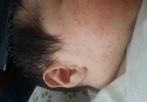 治療新生兒臉上濕疹小妙招