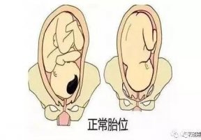 胎位不正，看這篇就夠了