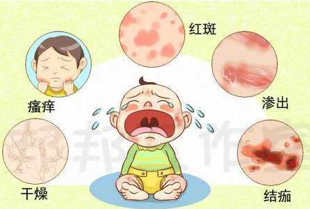 新生兒濕疹的癥狀及護(hù)理方法