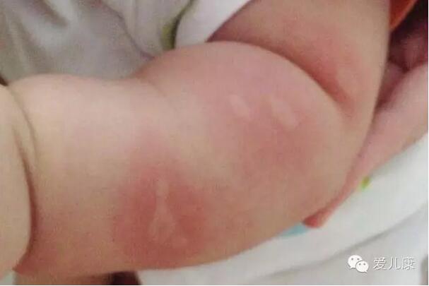 寶寶被蚊子咬了怎么辦