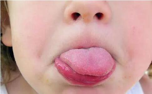 嬰兒舌苔厚白是怎么回事
