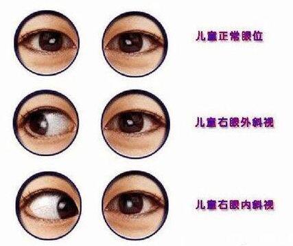 嬰兒斗雞眼怎么辦