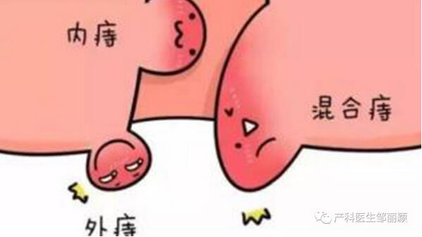 孕婦長痔瘡怎么辦