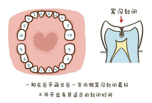 兒童牙齒窩溝封閉有必要做嗎