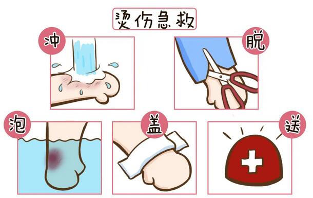 燙傷后怎么處理？錯(cuò)誤處理方式可危及生命