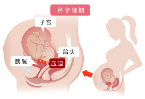 孕期憋尿是大忌，4招幫你減輕孕婦尿頻