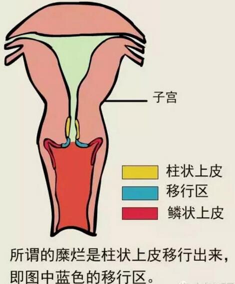 宮頸糜爛不是病