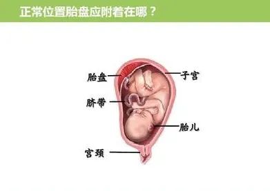 關(guān)于前置胎盤，你需要了解的事兒