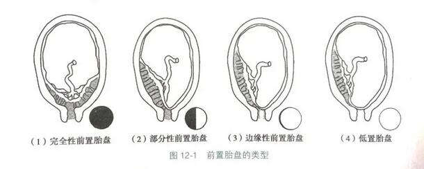關(guān)于前置胎盤，你需要了解的事兒