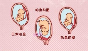 關(guān)于前置胎盤，你需要了解的事兒