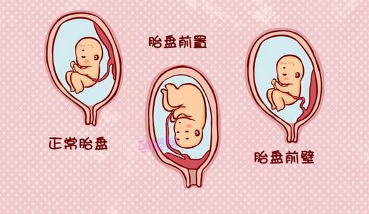 關(guān)于前置胎盤，你需要了解的事兒