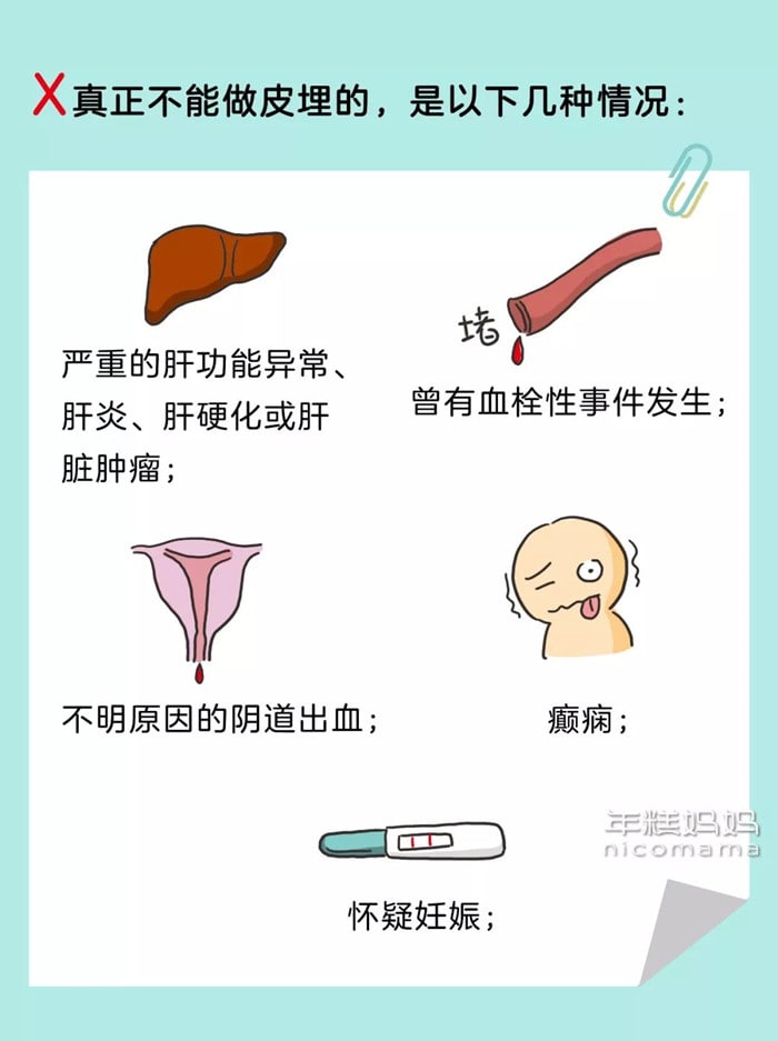 皮下埋植避孕法，不結(jié)扎不吃藥