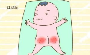 護(hù)臀膏能治療寶寶的紅屁屁嗎？