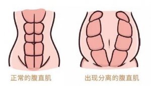 腹直肌分離是怎么回事？該怎么恢復(fù)？