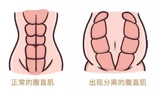 腹直肌分離是怎么回事？該怎么恢復(fù)？