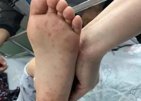 夏季傳染病頻發(fā)，請家長做好這6件事