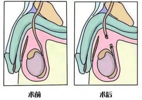 男性結(jié)扎后影響啪啪啪嗎？精子都去哪了？