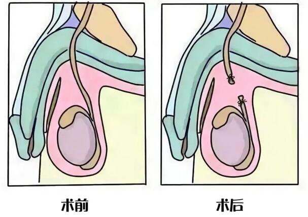 男性結(jié)扎后影響啪啪啪嗎？精子都去哪了？