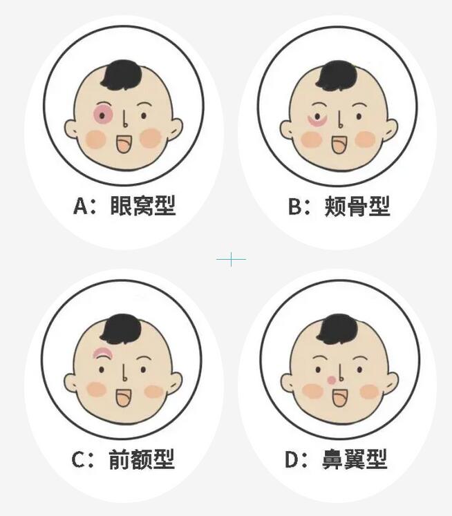 胎記是好東西嘛 做一個簡單的歸類