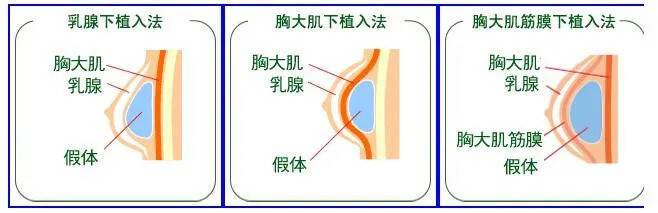 隆胸可以喂奶嗎