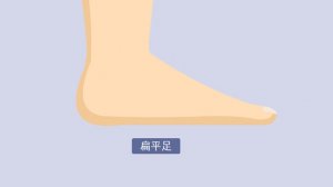 扁平足怎么判斷
