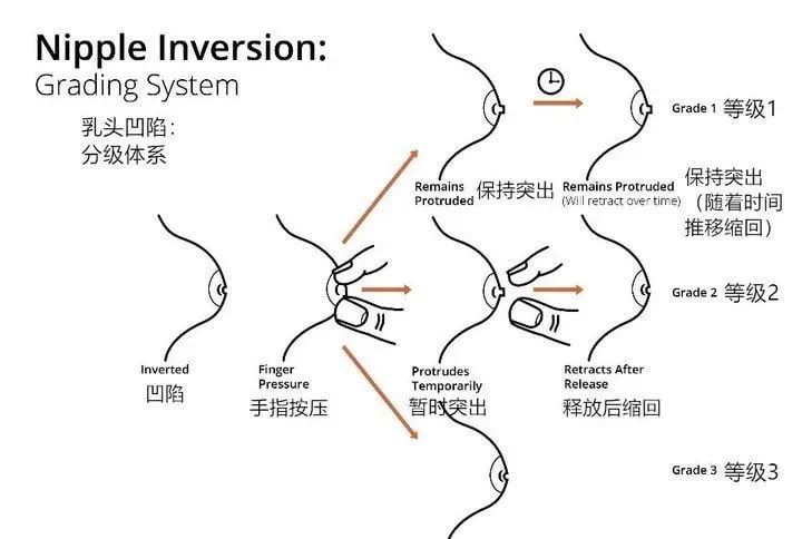 乳頭內(nèi)陷怎么辦