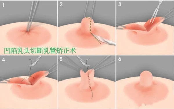 乳頭內(nèi)陷怎么辦