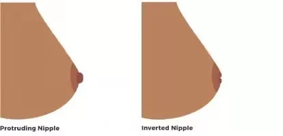 乳頭內(nèi)陷怎么辦