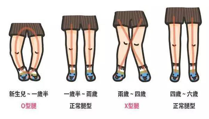 寶寶腿不直怎么辦 x型腿怎么矯正