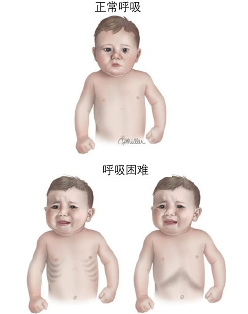 怎么判斷是不是得了小兒肺炎？