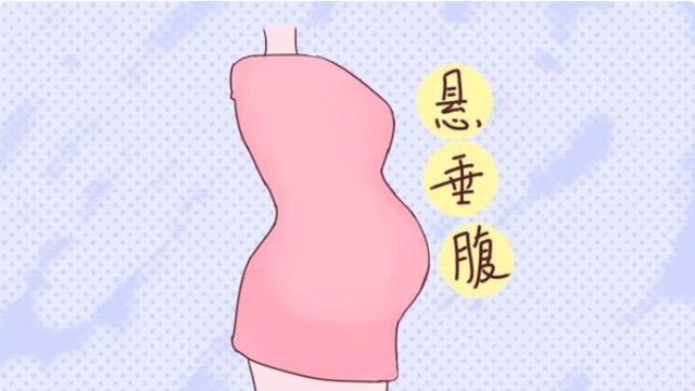 懸垂腹是不是只能剖？