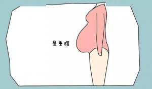 懸垂腹是不是只能剖？