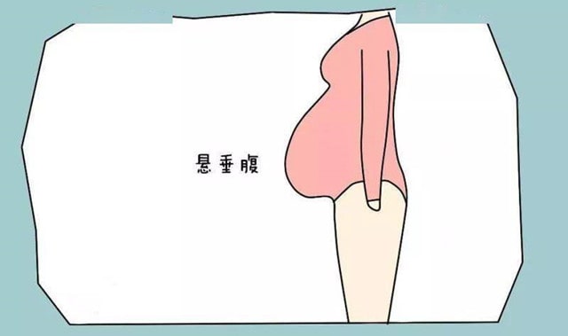 懸垂腹是不是只能剖？