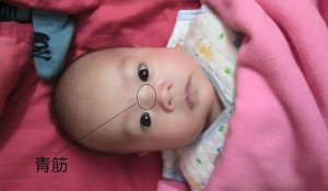 寶寶鼻梁上有青筋明顯是怎么回事