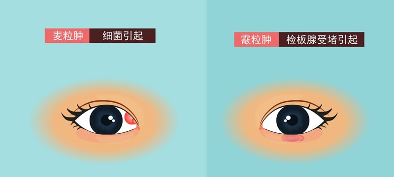 霰粒腫和麥粒腫的區(qū)別