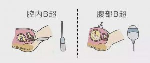 陰超檢查和b超的區(qū)別
