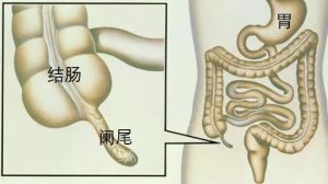 小兒闌尾炎怎么辦
