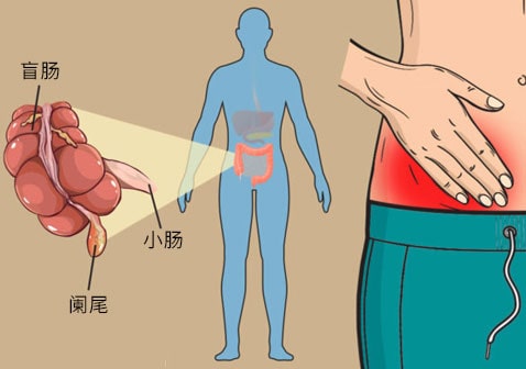 闌尾炎是哪個(gè)部位疼 位置圖