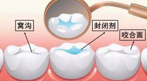 牙齒窩溝封閉是什么意思
