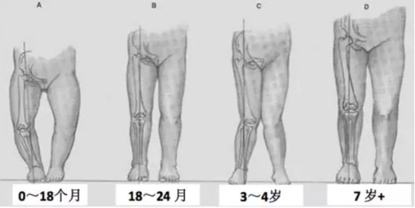 寶寶腿不直怎么辦