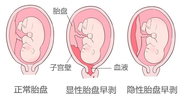 孕晚期腹痛不只是胎動(dòng)