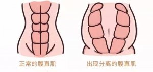 產(chǎn)后腹直肌分離，不處理會(huì)怎么樣？
