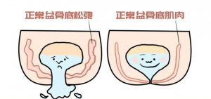 產(chǎn)后盆底肌松弛有什么癥狀