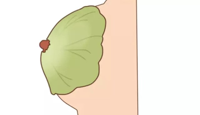 哺乳期乳房腫脹疼痛怎么辦？