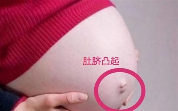 孕婦肚臍有凹有凸，和生男生女有關(guān)？