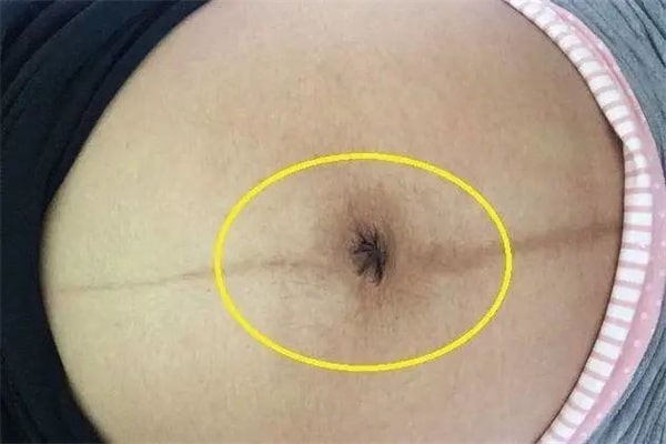 孕婦肚臍有凹有凸，和生男生女有關(guān)？
