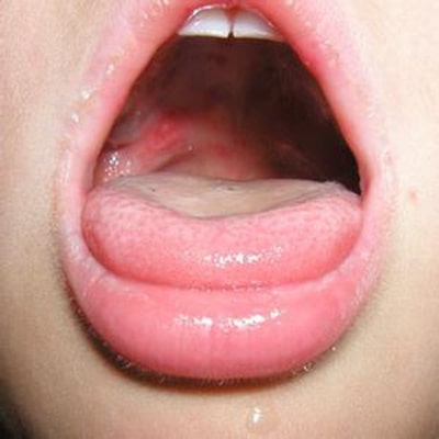 手足口病癥狀初期圖片