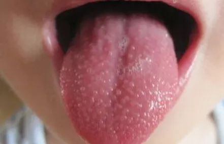 春季請(qǐng)警惕小兒高發(fā)的這8種皮疹