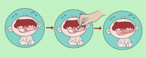 嬰兒鵝口瘡最佳治療方法